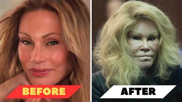 Get To Know Charo's Transformation: Before The Surgery