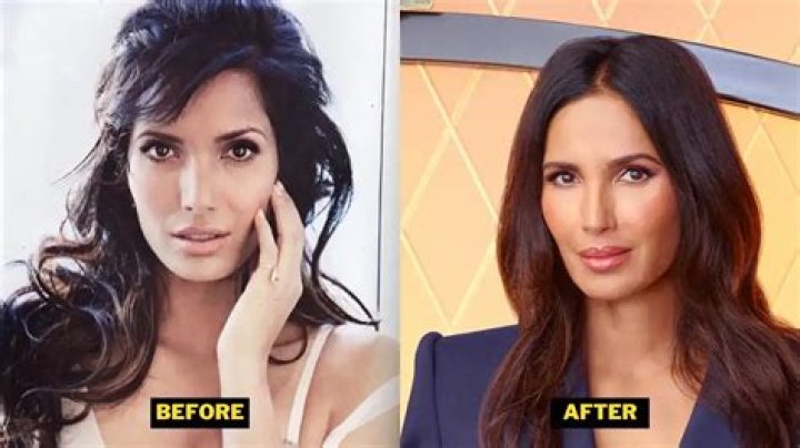Padma Lakshmi Surgery: All You Need To Know
